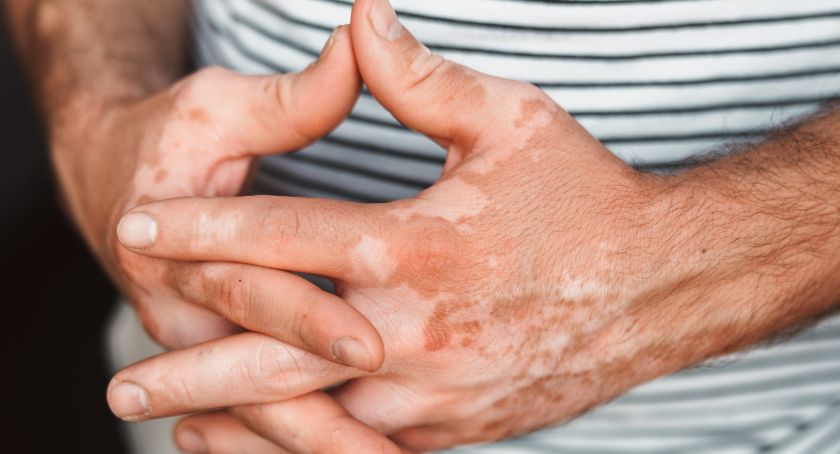 AbbVie Submits Regulatory Applications for Rinvoq in Patients with Vitiligo